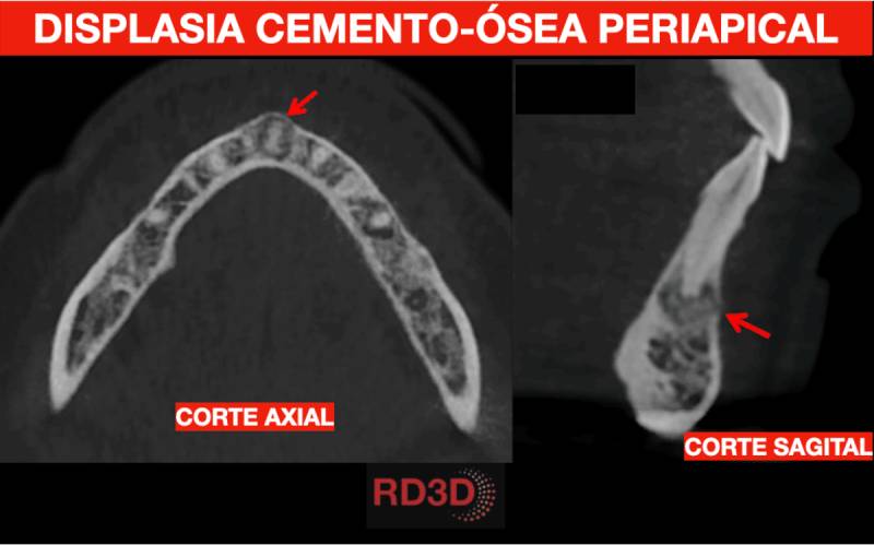 Displasia cemento-ósea periapical