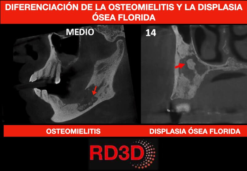 Diferenciación mediante CBCT de la displasia ósea florida y la osteomielitis.