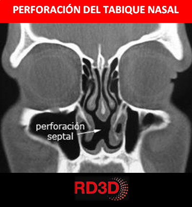 PERFORACION-TABIQUE-NASAL-CBCT